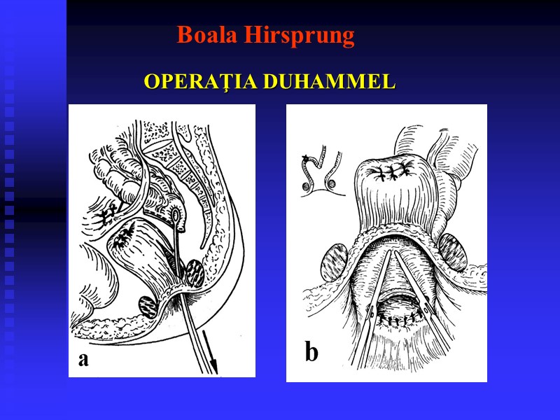 Boala Hirsprung  OPERAŢIA DUHAMMEL